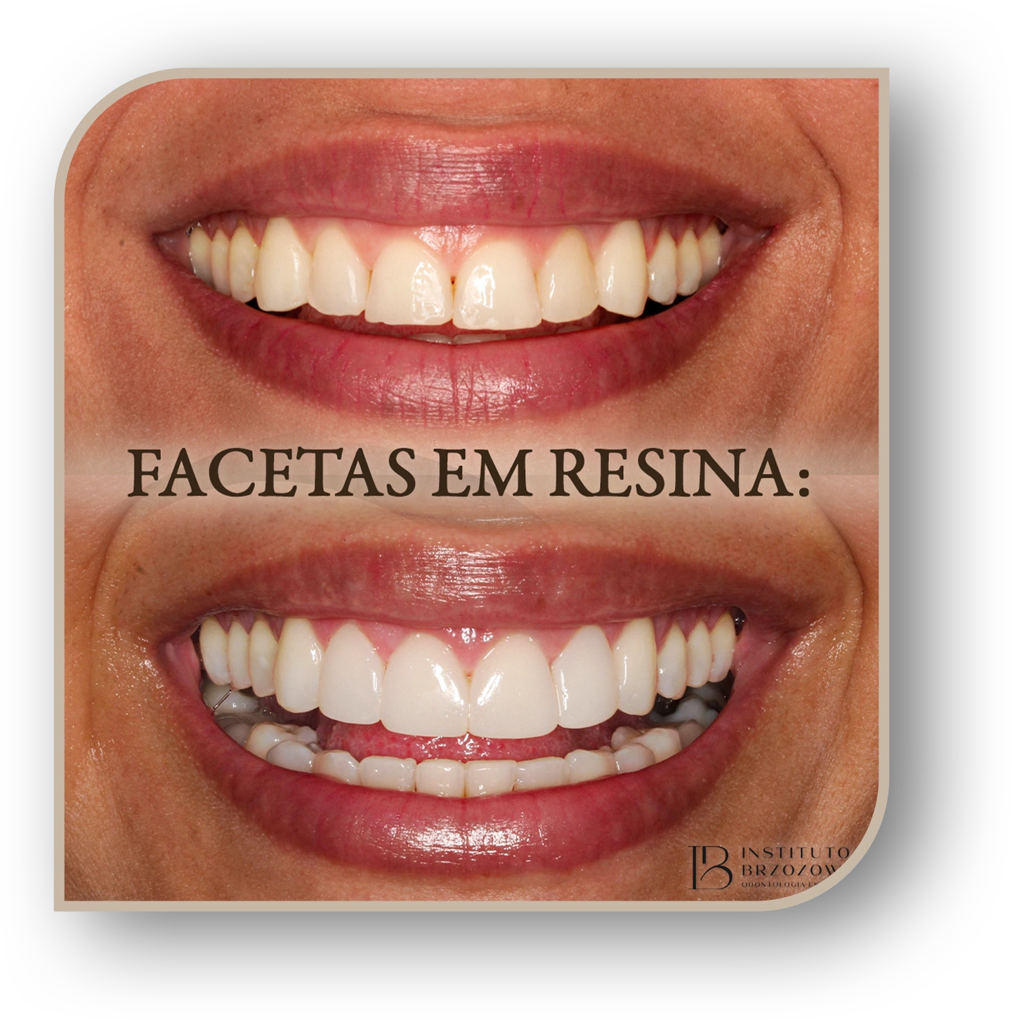 faceta em resina