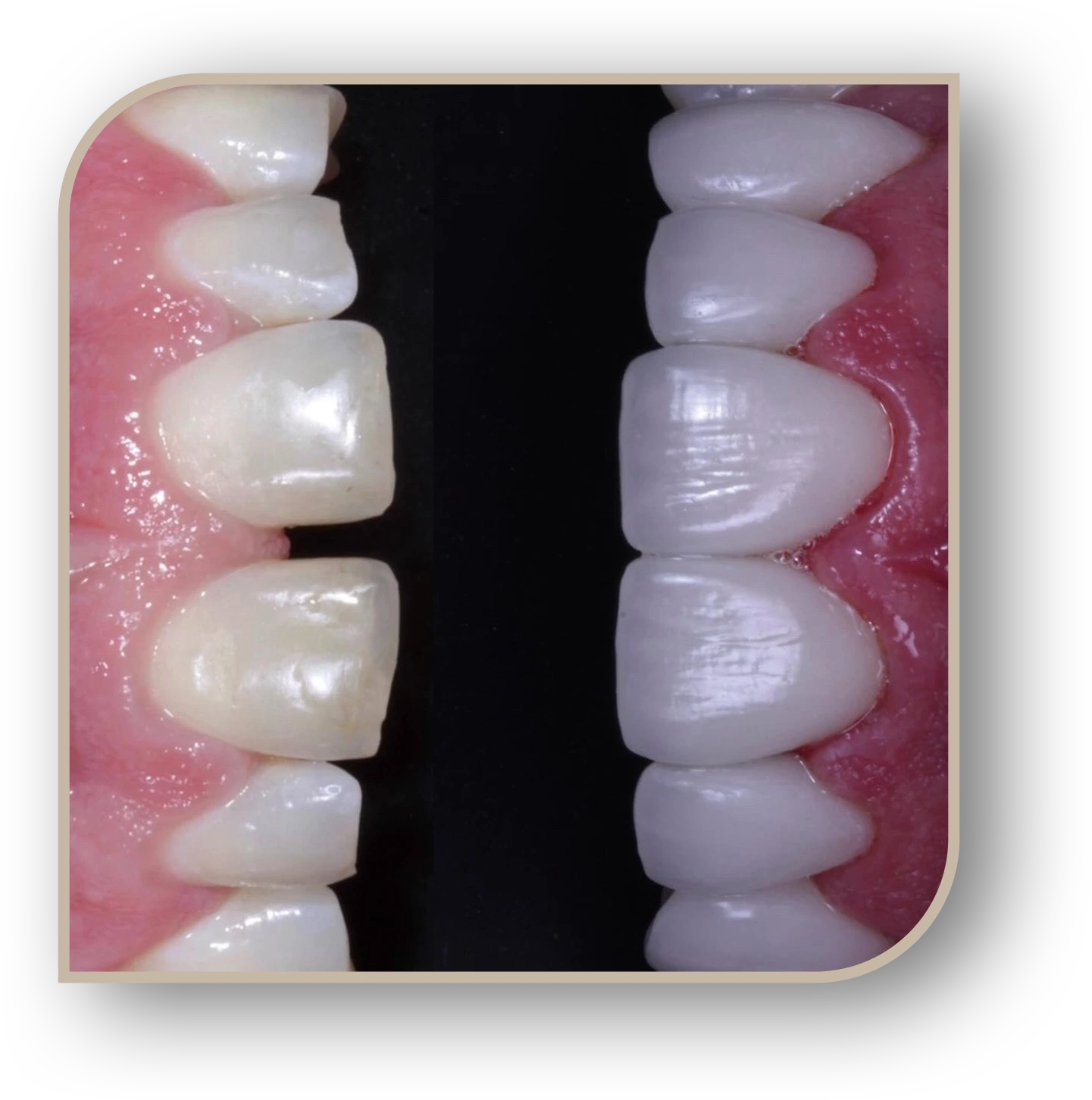 lente de porcelana